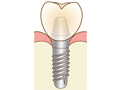 インプラント