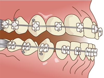 ワイヤー矯正治療