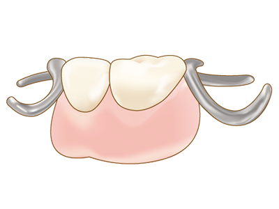 入れ歯(取り外し式の人工の歯です)