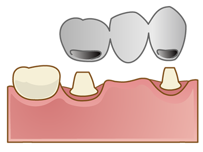 ブリッジ(固定式の被せ物です)